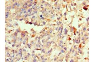 Immunohistochemistry of paraffin-embedded human melanoma using ABIN7166082 at dilution of 1:100 (40S Ribosomal Protein S3-B (RPS3.S) (AA 1-92) anticorps)