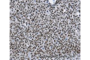 Immunohistochemistry of Human colon cancer using CMTM2 Polyclonal Antibody at dilution of 1:60 (CMTM2 anticorps)