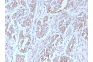 Formalin-fixed, paraffin-embedded human Colon Carcinoma stained with ICOS-L Mouse Monoclonal Antibody (ICOSL/3111). (ICOSLG anticorps  (AA 23-149))