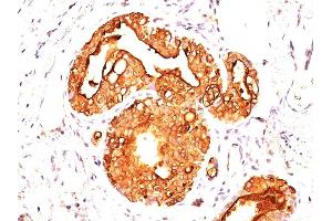 Formalin-fixed, paraffin-embedded human Breast Carcinoma stained with MUC-1 / CA15-3 / EMA Mouse Monoclonal Antibody (MUC1/955).