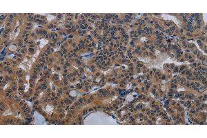Immunohistochemistry of paraffin-embedded Human thyroid cancer tissue using INSIG2 Polyclonal Antibody at dilution 1:30 (INSIG2 anticorps)