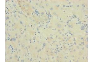 Immunohistochemistry of paraffin-embedded human liver cancer using ABIN7150510 at dilution of 1:100 (DNAJB14 anticorps  (AA 1-244))
