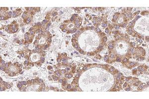 ABIN6272771 at 1/100 staining Human liver cancer tissue by IHC-P.