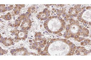 ABIN6272771 at 1/100 staining Human liver cancer tissue by IHC-P. (OR4N2 anticorps)