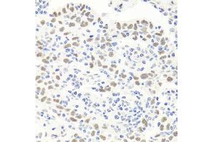 Immunohistochemistry of paraffin-embedded human esophageal cancer using EXO1 antibody (ABIN6129824, ABIN6140356, ABIN6140357 and ABIN6219087) at dilution of 1:100 (40x lens). (Exonuclease 1 anticorps  (AA 601-846))