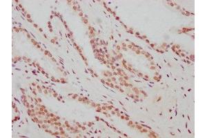 IHC image of ABIN7127344 diluted at 1:183 and staining in paraffin-embedded human prostate cancer performed on a Leica BondTM system.