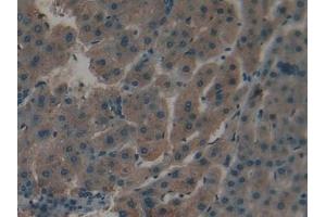 Detection of APOC1 in Human Liver cancer Tissue using Polyclonal Antibody to Apolipoprotein C1 (APOC1)