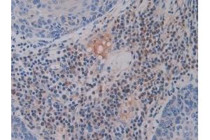 Detection of Hepc in Human Skin cancer Tissue using Monoclonal Antibody to Hepcidin (Hepc)