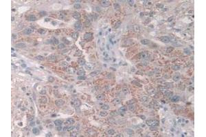 IHC-P analysis of Human Breast Cancer Tissue, with DAB staining. (GRB10 anticorps  (AA 392-594))
