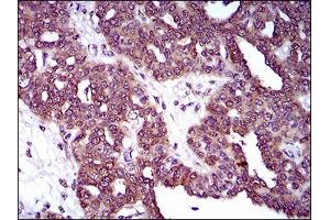 Immunohistochemical analysis of paraffin-embedded ovarian cancer tissues using DNM1L mouse mAb with DAB staining.