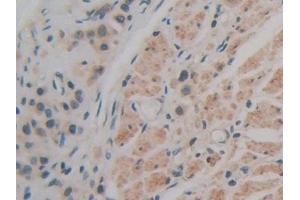 Detection of CD147 in Human Stomach cancer Tissue using Polyclonal Antibody to Cluster Of Differentiation 147 (CD147)