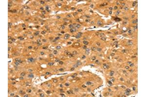 The image on the left is immunohistochemistry of paraffin-embedded Human liver cancer tissue using ABIN7192437(SLC24A4 Antibody) at dilution 1/35, on the right is treated with synthetic peptide.