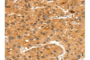 The image on the left is immunohistochemistry of paraffin-embedded Human liver cancer tissue using ABIN7192437(SLC24A4 Antibody) at dilution 1/35, on the right is treated with synthetic peptide. (SLC24A4 anticorps)
