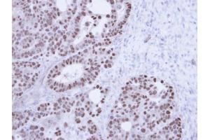 IHC-P Image Immunohistochemical analysis of paraffin-embedded NCIN87 Xenograft , using TAP , antibody at 1:100 dilution. (NXF1 anticorps  (N-Term))