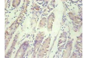 Immunohistochemical of paraffin-embedded human gastric cancer tissue using ABIN7156932 at dilution of 1:200. (IL-8 anticorps)