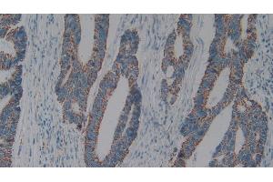 Detection of C1QBP in Human Colorectal cancer Tissue using Polyclonal Antibody to Complement component 1 Q subcomponent-binding protein, mitochondrial (C1QBP)