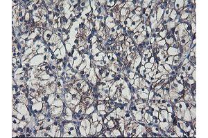 Immunohistochemical staining of paraffin-embedded Carcinoma of Human kidney tissue using anti-SH2D2A mouse monoclonal antibody. (SH2D2A anticorps)