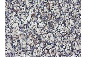 Immunohistochemical staining of paraffin-embedded Carcinoma of Human kidney tissue using anti-SH2D2A mouse monoclonal antibody. (SH2D2A anticorps)