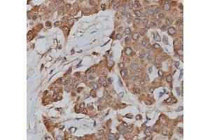 ABIN6279217 at 1/200 staining human lymphoma tissue sections by IHC-P. (slc25a13 anticorps  (C-Term))