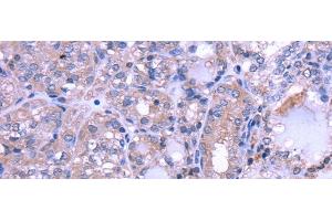 Immunohistochemistry of paraffin-embedded Human thyroid cancer using THRSP Polyclonal Antibody at dilution of 1/30 (THRSP anticorps)