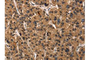 The image on the left is immunohistochemistry of paraffin-embedded Human liver cancer tissue using ABIN7190461(DEFA5 Antibody) at dilution 1/15, on the right is treated with synthetic peptide. (DEFA5 anticorps)