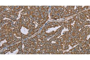 Immunohistochemistry of paraffin-embedded Human ovarian cancer using CERS4 Polyclonal Antibody at dilution of 1:35