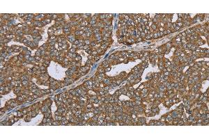Immunohistochemistry of paraffin-embedded Human ovarian cancer using CERS4 Polyclonal Antibody at dilution of 1:35 (LASS4 anticorps)