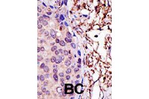 Formalin-fixed and paraffin-embedded human cancer tissue reacted with UBE2L3 polyclonal antibody  , which was peroxidase-conjugated to the secondary antibody, followed by AEC staining. (UBE2L3 anticorps  (N-Term))