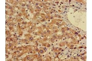 Immunohistochemistry of paraffin-embedded human liver cancer using ABIN7155691 at dilution of 1:100