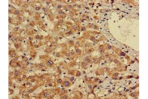 Immunohistochemistry of paraffin-embedded human liver cancer using ABIN7155691 at dilution of 1:100 (EN2 anticorps  (AA 1-251))