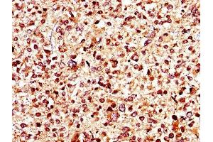 IHC image of ABIN7145017 diluted at 1:400 and staining in paraffin-embedded human glioma performed on a Leica BondTM system. (KCNJ1 anticorps  (AA 165-379))