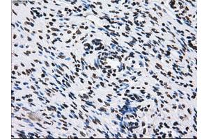 Immunohistochemical staining of paraffin-embedded Adenocarcinoma of breast tissue using anti-ID3 mouse monoclonal antibody. (ID3 anticorps)