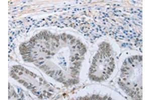 The image on the left is immunohistochemistry of paraffin-embedded Human colon cancer tissue using ABIN7191633(NEUROG2 Antibody) at dilution 1/15, on the right is treated with synthetic peptide. (Neurogenin 2 anticorps)