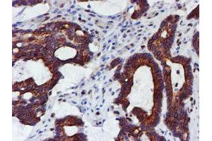 Immunohistochemical staining of paraffin-embedded Adenocarcinoma of Human colon tissue using anti-MEF2C mouse monoclonal antibody. (MEF2C anticorps)