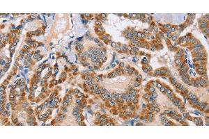 Immunohistochemistry of paraffin-embedded Human thyroid cancer using MSMB Polyclonal Antibody at dilution of 1:30