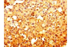Immunohistochemistry of paraffin-embedded human breast cancer using ABIN7151123 at dilution of 1:100 (RNF13 anticorps  (AA 432-685))