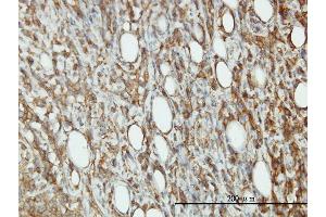 Immunoperoxidase of monoclonal antibody to EIF5 on formalin-fixed paraffin-embedded human malignant lymphoma, diffuse large B tissue.