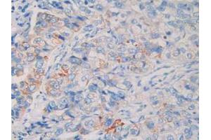 IHC-P analysis of Human Breast Cancer Tissue, with DAB staining. (MME anticorps  (AA 382-538))