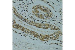 Immunohistochemistry of paraffin-embedded human breast cancer using RSRC1 antibody (ABIN6131423, ABIN6147283, ABIN6147284 and ABIN6223040) at dilution of 1:100 (40x lens).
