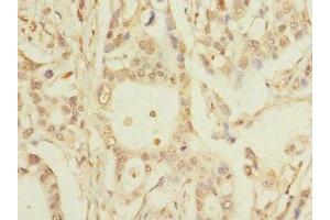 Immunohistochemistry of paraffin-embedded human pancreatic cancer using ABIN7163816 at dilution of 1:100 (PKD2L2 anticorps  (AA 390-523))