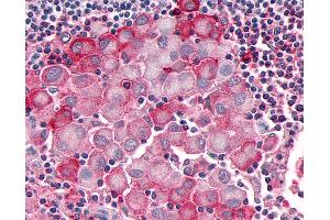 Anti-OR10R2 antibody IHC of human Skin, Melanoma. (OR10R2 anticorps  (Extracellular Domain))