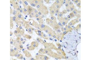Immunohistochemistry of paraffin-embedded Human liver damage using ABCB8 Polyclonal Antibody at dilution of 1:100 (40x lens). (ABCB8 anticorps)