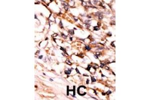 Formalin-fixed and paraffin-embedded human hepatocellular carcinoma tissue reacted with MAPKAPK5 (phospho S93) polyclonal antibody  which was peroxidase-conjugated to the secondary antibody followed by DAB staining. (MAPKAP Kinase 5 anticorps  (pSer93))