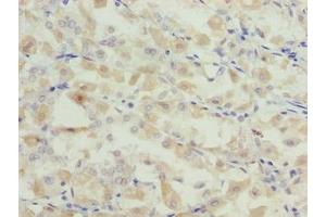 Immunohistochemistry of paraffin-embedded human gastric cancer using ABIN7153839 at dilution of 1:100 (GCSAML anticorps  (AA 1-135))