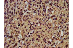 IHC image of ABIN7164940 diluted at 1:400 and staining in paraffin-embedded human glioma performed on a Leica BondTM system. (POMP anticorps  (AA 1-141))