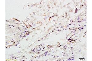Formalin-fixed and paraffin embedded:human colon carcinoma labeled with Anti-factor VIII(FVIII)(human) Polyclonal Antibody , Unconjugated at 1:200, followed by conjugation to the secondary antibody and DAB staining