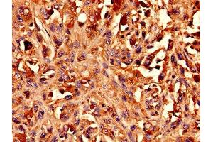 Immunohistochemistry analysis of human melanoma using ABIN7145741 at dilution of 1:100 (BCAT1 anticorps  (AA 4-276))