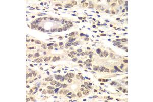 Immunohistochemistry of paraffin-embedded human colon carcinoma using CCNC antibody at dilution of 1:100 (x40 lens). (Cyclin C anticorps)