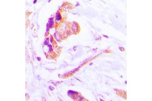 Immunohistochemical analysis of Caspase 3 p17 staining in human lung cancer formalin fixed paraffin embedded tissue section. (Caspase 3 p17 (Center) anticorps)