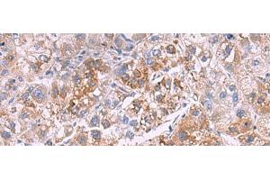 Immunohistochemistry of paraffin-embedded Human liver cancer tissue using GSTCD Polyclonal Antibody at dilution of 1:70(x200) (GSTCD anticorps)